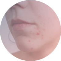 dermatologia-acne